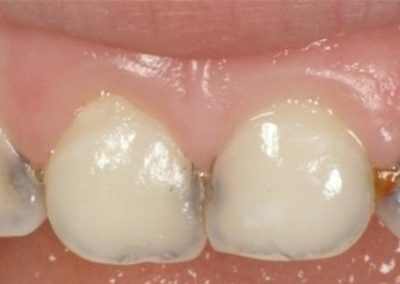 denti-latte-2